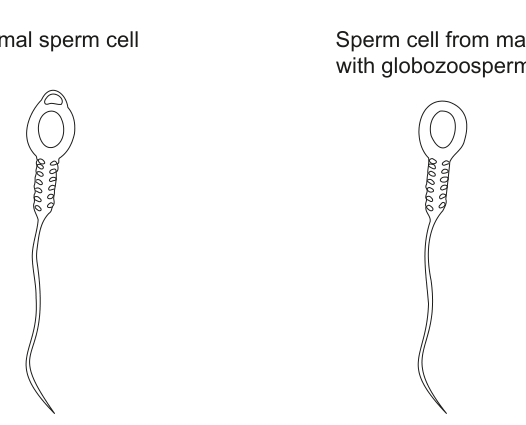 Diagram showing a normal sperm cell and a sperm cell from a male with globozoospermia, illustrating the morphological difference.