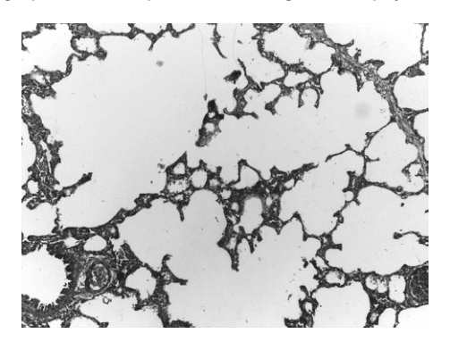 Micrograph showing air pockets resulting from emphysema, as described in Question 23.