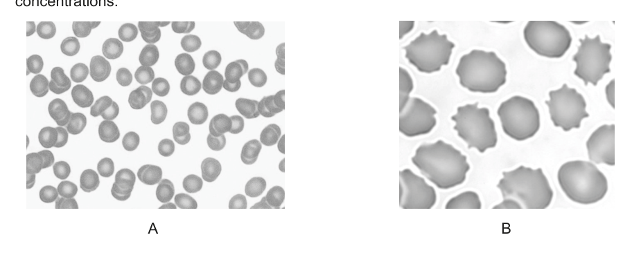Two micrographs, labeled A and B, showing red blood cells. Micrograph A shows normal-looking red blood cells, while micrograph B shows crenated red blood cells.