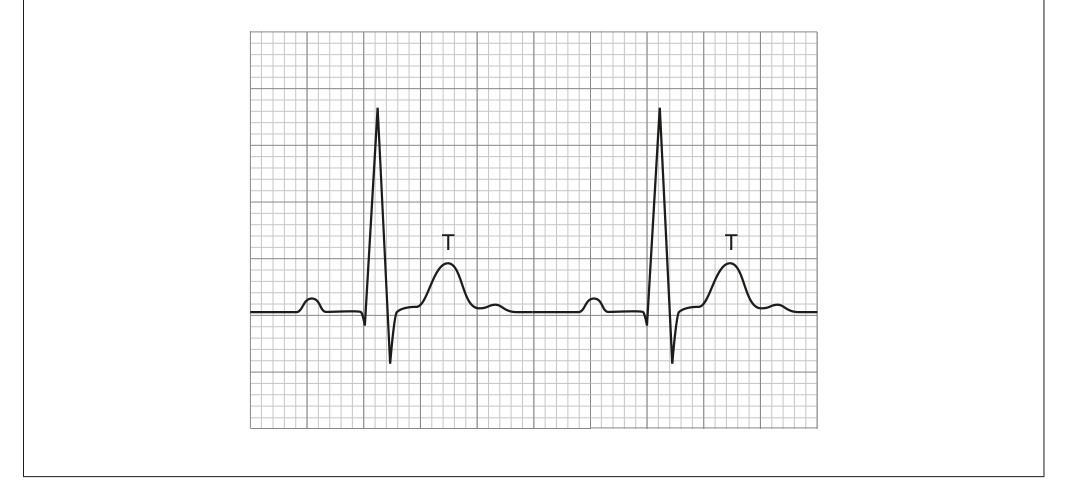 A diagram showing a normal electrocardiogram (ECG) trace with two cardiac cycles, including the T wave.